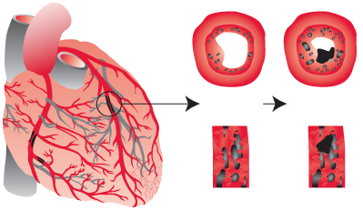 Hk Strickland, medical illustration, angina, cardiology drawings